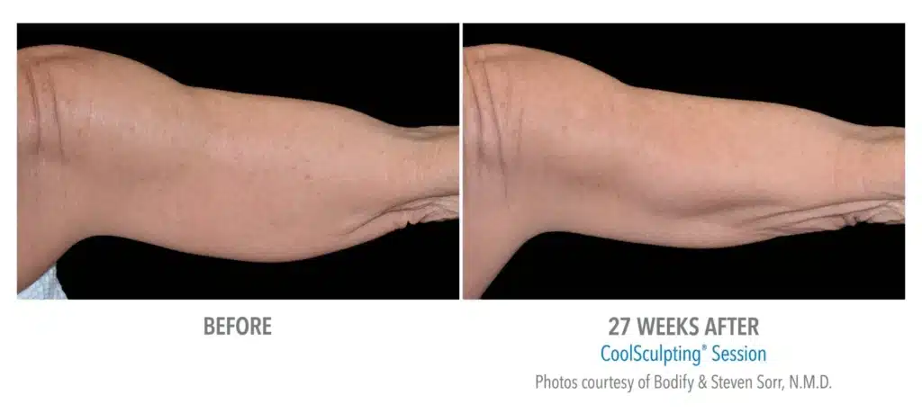 superb sculpting fat reduce 27 week before and after images