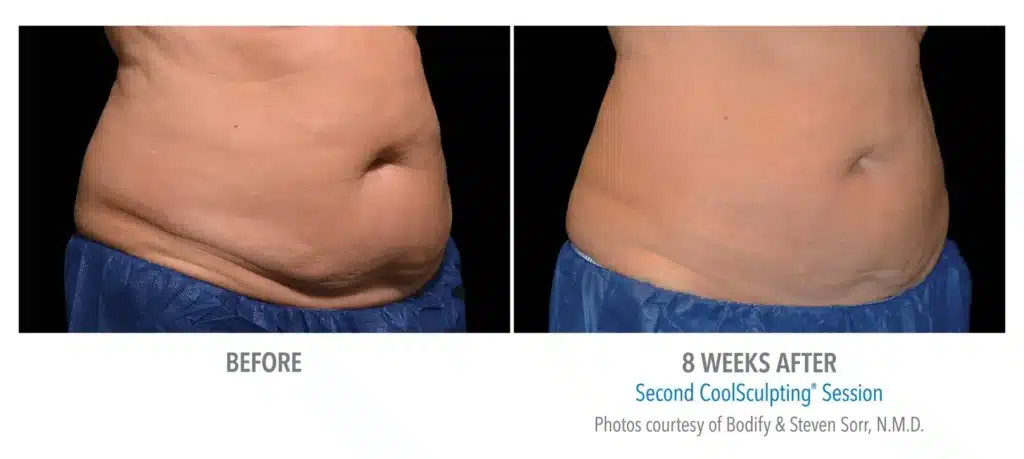 superb sculpting fat reduce 8 weeks before and after images