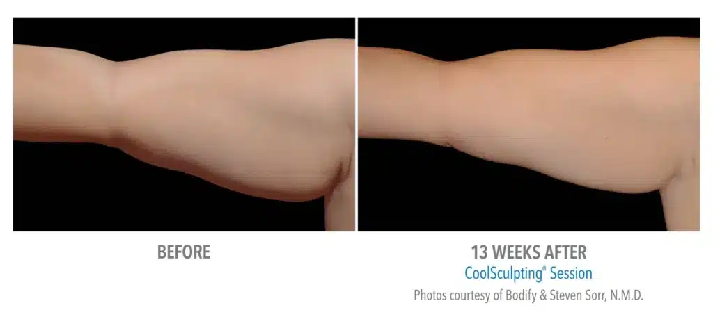 superb sculpting fat reduce 13 week before and after images