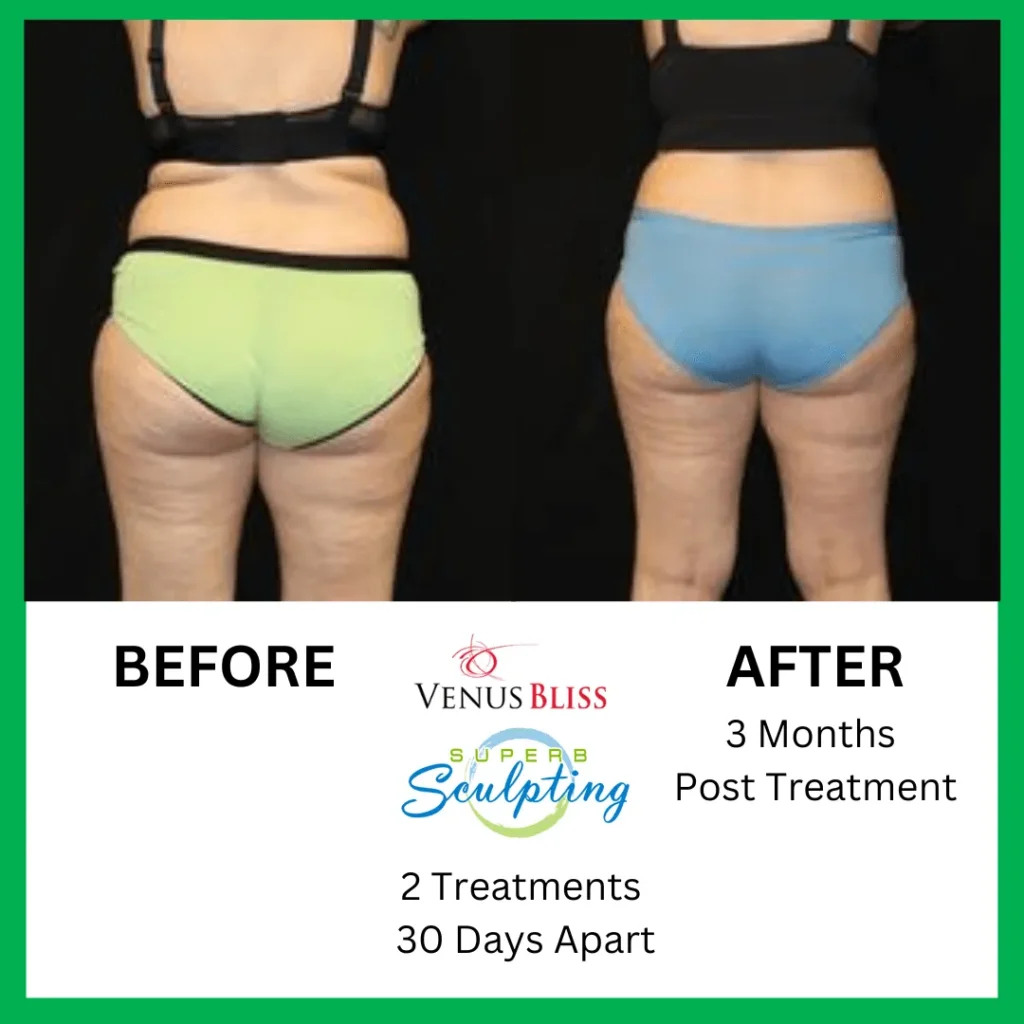superb sculpting fat reduce 3 month before and after images