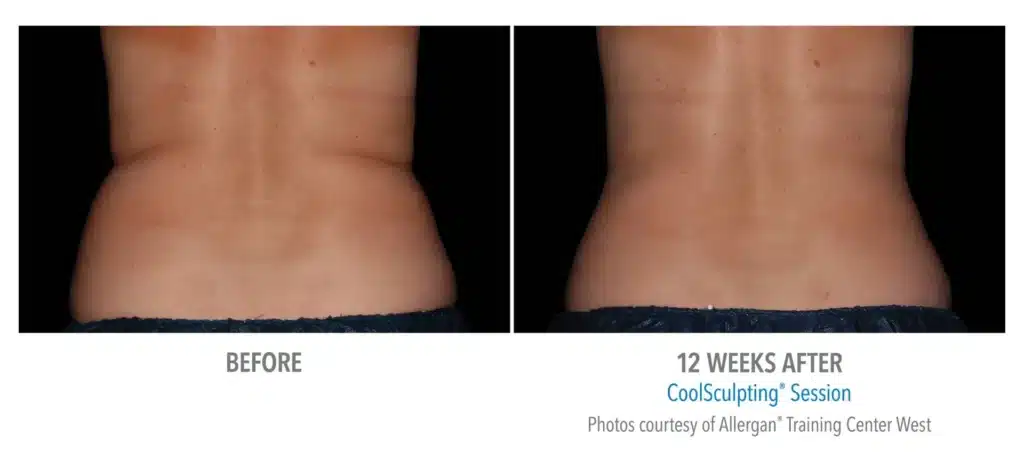 superb sculpting fat reduce 12 week before and after images