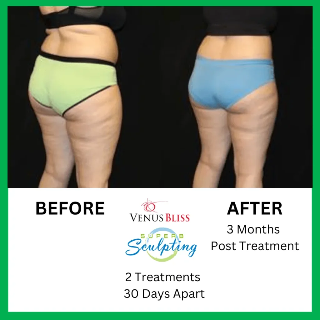 superb sculpting fat reduce 30 days before and after images