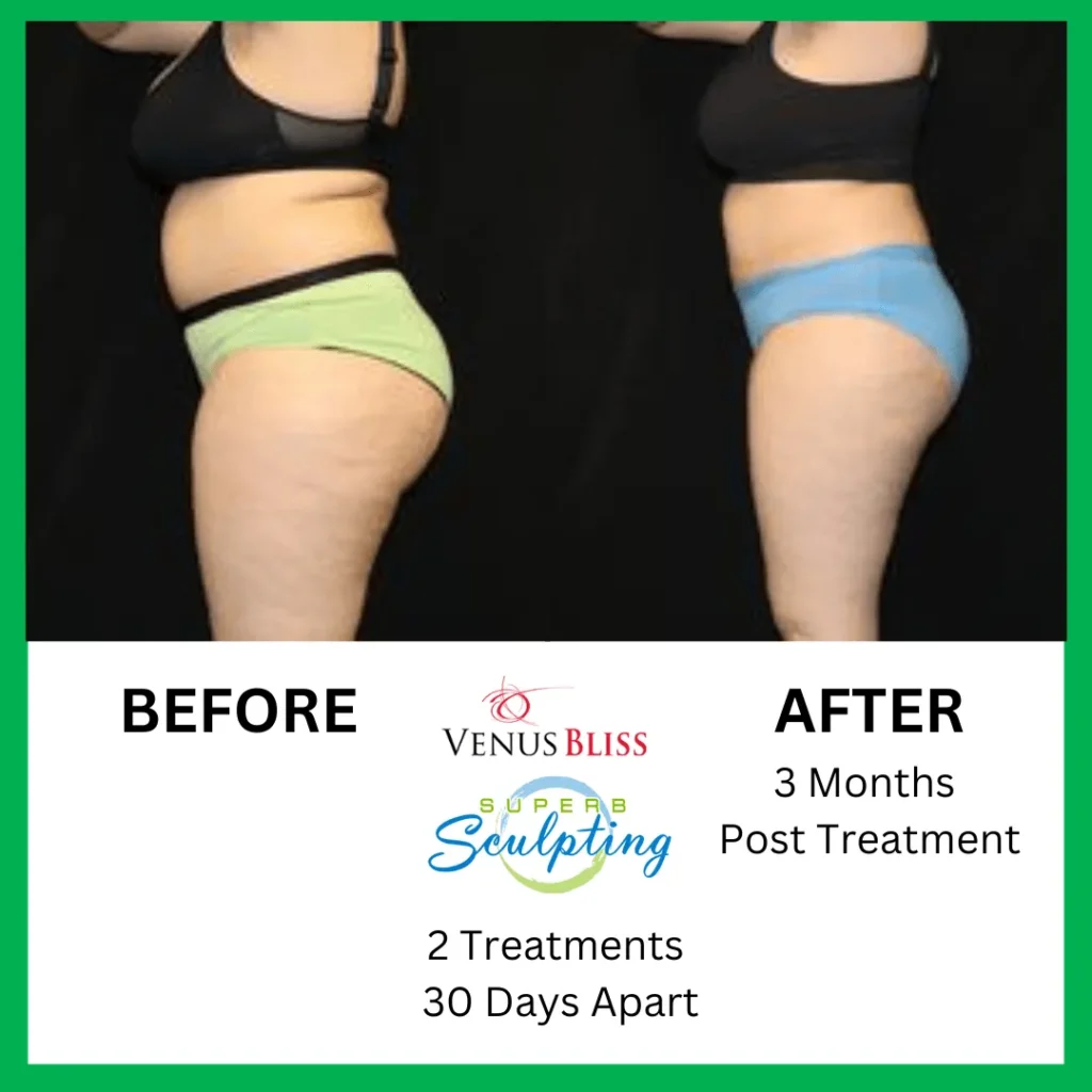 superb sculpting fat reduce 90 days before and after images