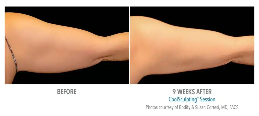 superb sculpting fat reduce 9 week before and after images