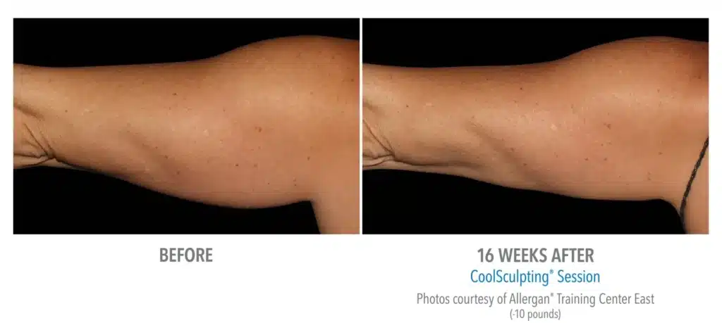 superb sculpting fat reduce 16 week before and after images