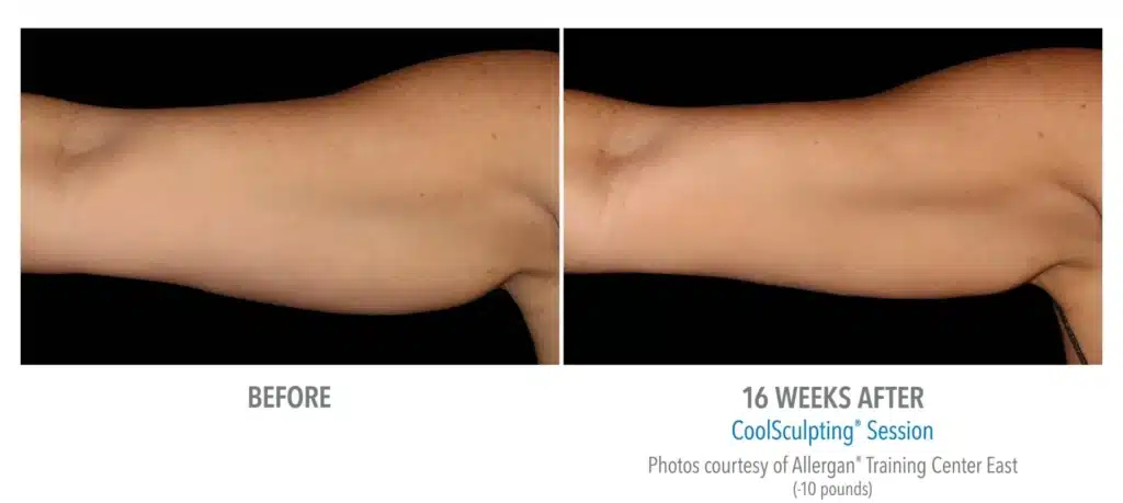 superb sculpting fat reduce 16 week before and after images