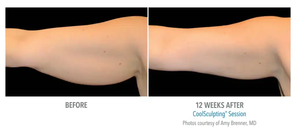 superb sculpting fat reduce 12 week before and after images