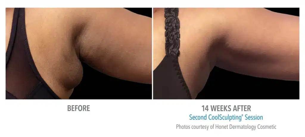 superb sculpting fat reduce 14 week before and after images