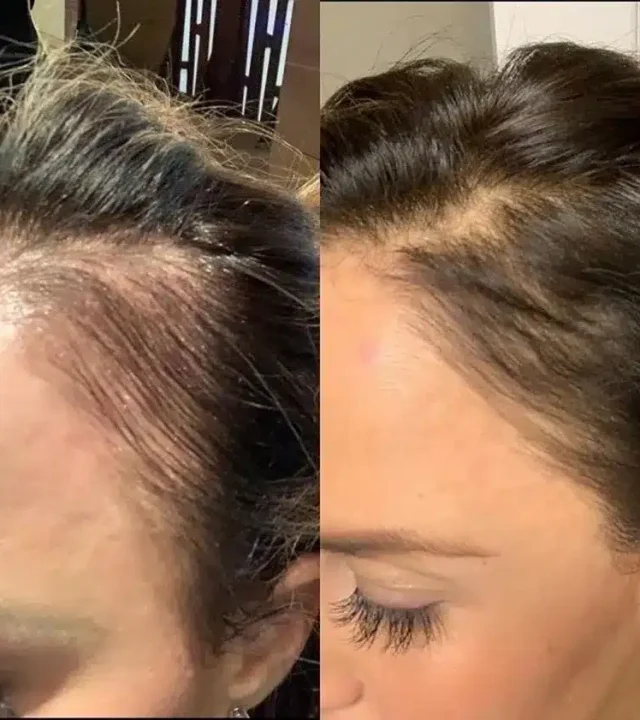 Keravive before and after